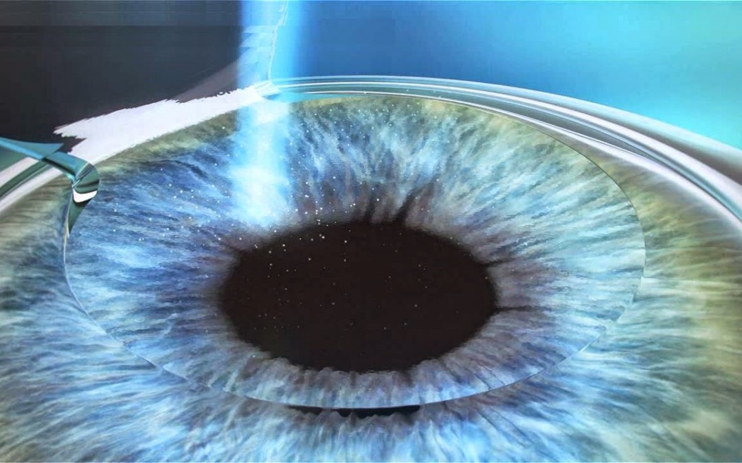 CIRUGIA REFRACTIVA