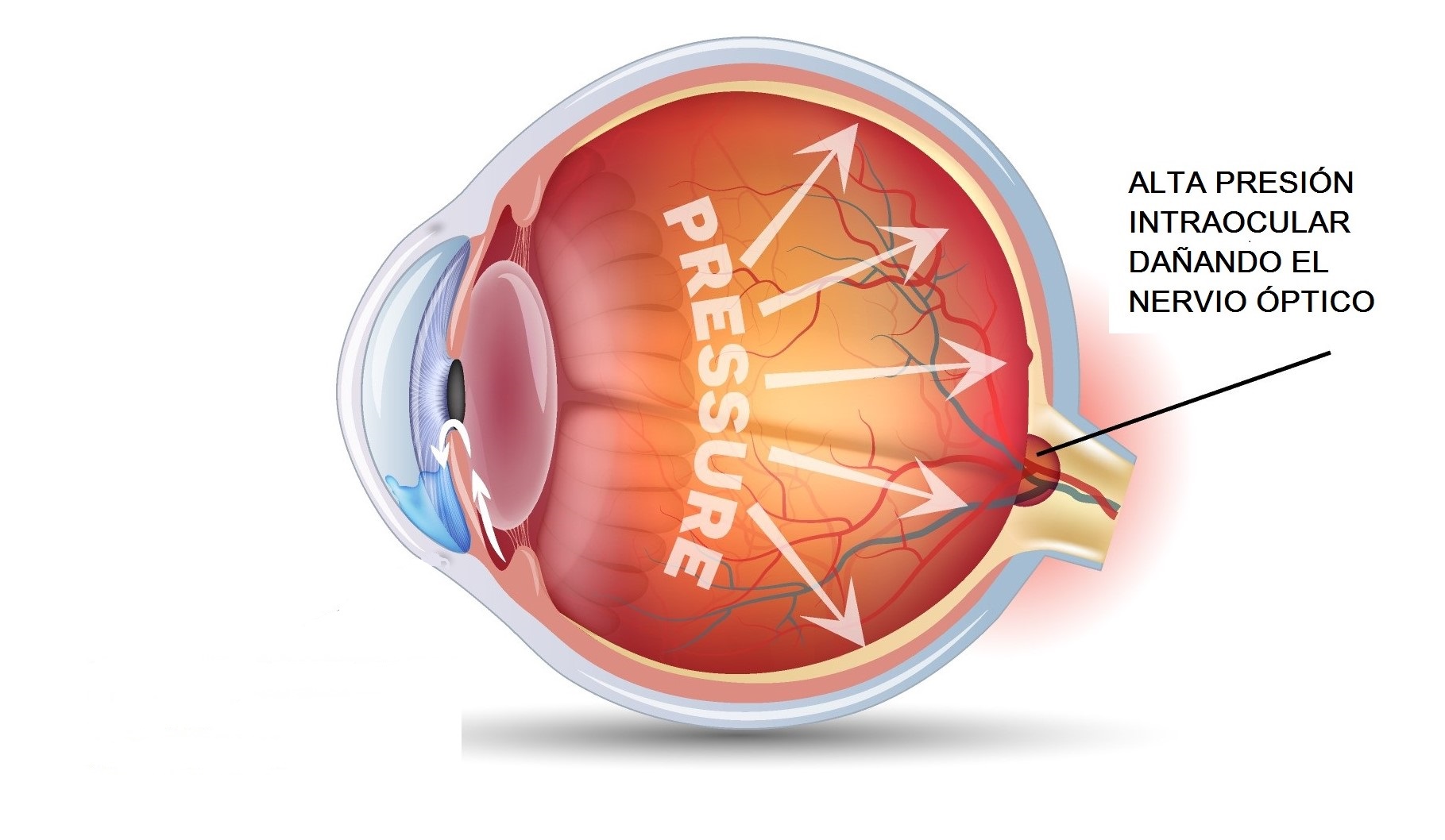 glaucoma