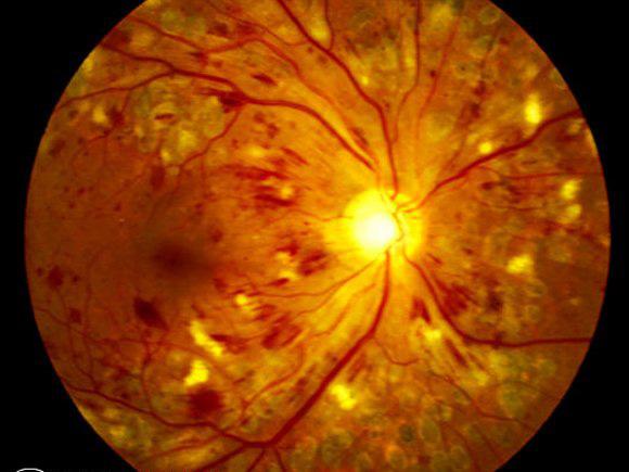 RETINOPATIA DIABETICA