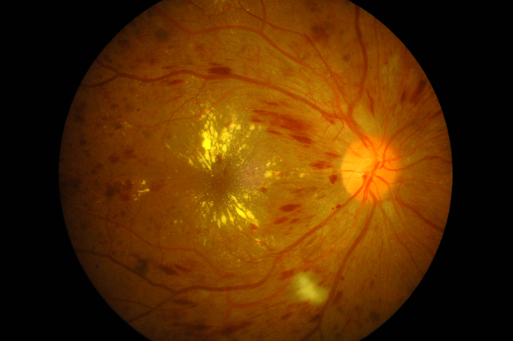 RETINOPATIA DIABETICA